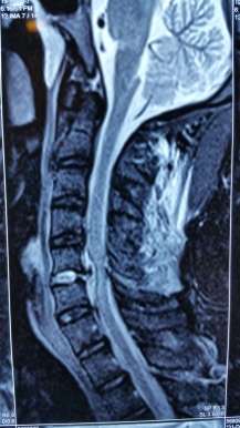 MRI showing anterior and posterior oedema -- white out