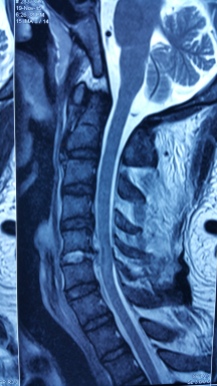 C56 disc herniated with cord compression