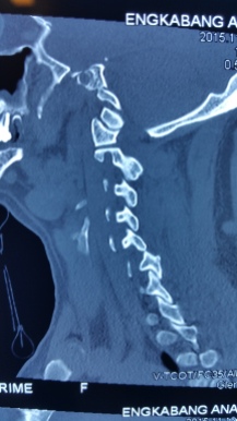 CT scan Dislocated facet C56